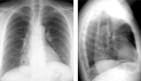 Chest X-ray findings in Achalasia