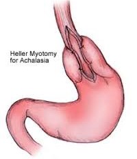 Myotomy and Partial Fundoplication for Achalasia