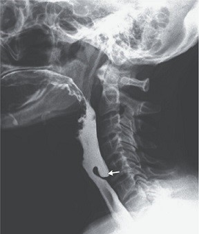 Barium Swallow Demonstrating a Zenker's Diverticulum