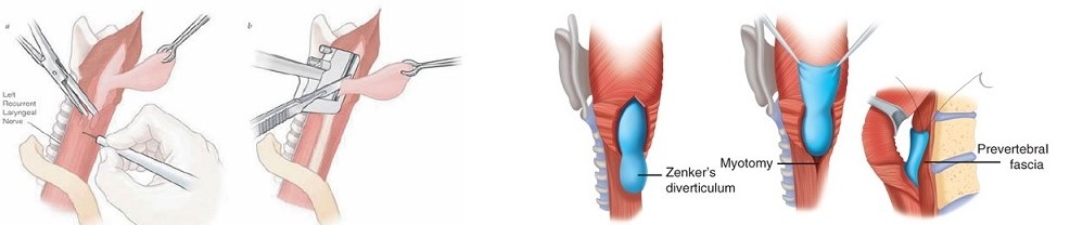 Diverticulectomy and Diverticulopexy for Zenker's Diverticulum