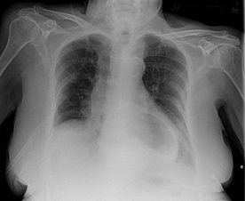 CXR Showing a Large Retrocardiac Air Bubble