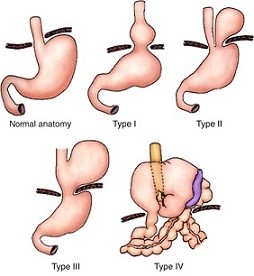 Classification of Hiatal Hernias