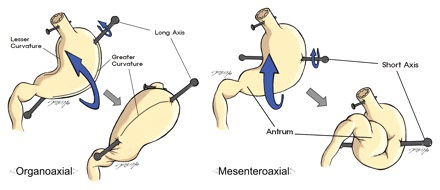 Types of Gastric Volvulus