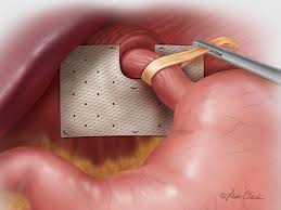 Mesh Reinforcement of Crural Closure