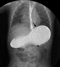 Organoaxial Gastric Volvulus