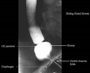 Type I Hiatal Hernia