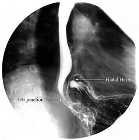 Type II Hiatal Hernia