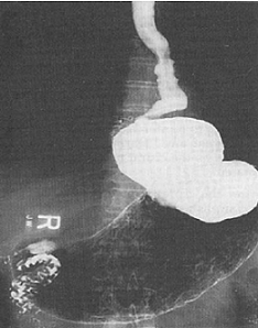 Type III Hiatal Hernia