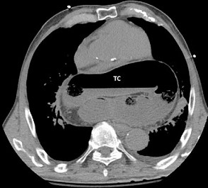 Type IV Hiatal Hernia Containing the Transverse Colon