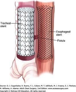 Combine Tracheal and Esophageal Stents for a Malignant TEF