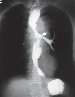 Esophagram Showing a Tracheoesophageal Fistula