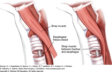 Primary Repair of a TEF