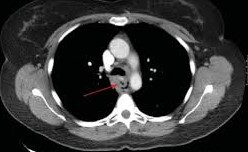 CT Scan showing Mediastinal Air and Esophageal Wall Thickening