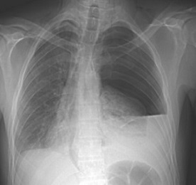 CXR Showing Mediastinal Air and a Left Pleual Effusion