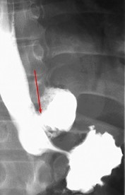 Esophagram Showing Free Perforation