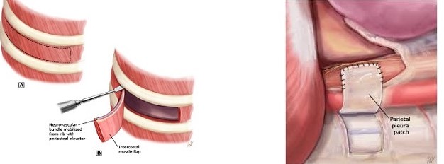 Intercostal Muscle Flap and Pleural Flap