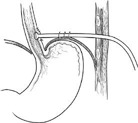 Esophageal T-tube Placement for Damage Control