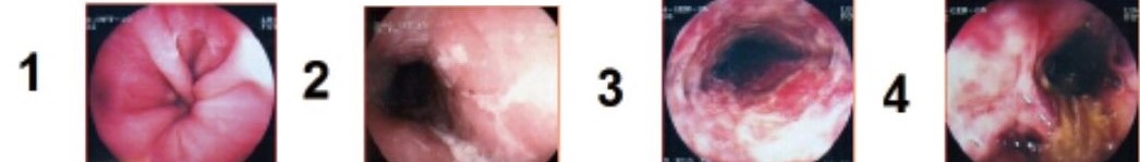 Endoscopic Caustic Injury Grades