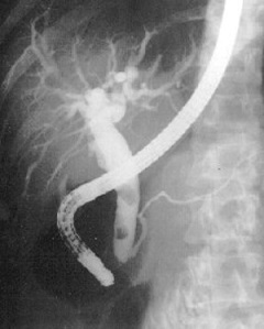 ERCP of Common Duct Stone