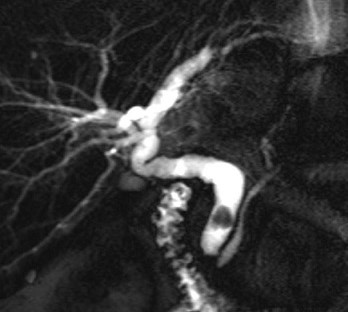 MRCP of Common Duct Stone