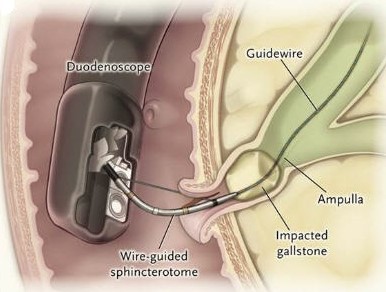 ERCP Sphincterotomy