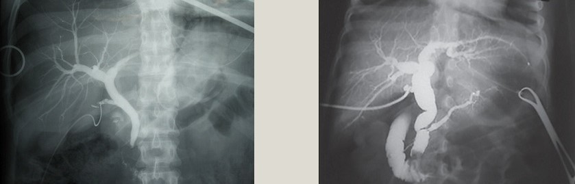 Positive Cholangiograms