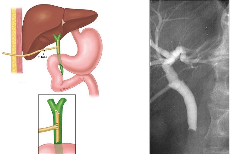 T-tube Cholangiogram with Retained Stone