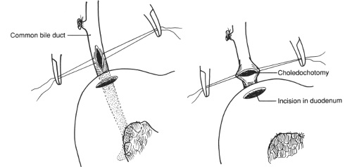 Choledochoduodenostomy