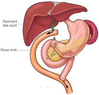 Hepaticojejunostomy