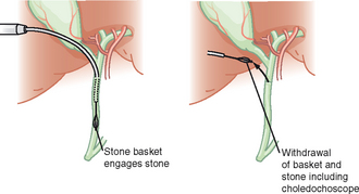 Laparoscopic CBDE