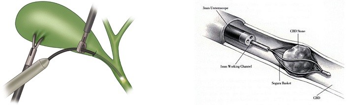 Laparoscopic Transcystic CBDE