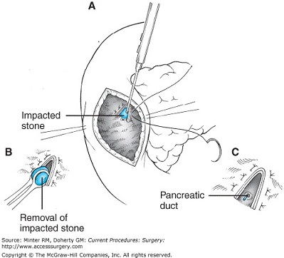 Transduodenal Sphincteroplasty