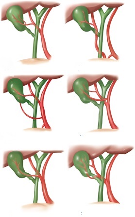 Cystic Artery Variations