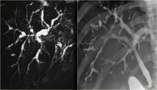 Sclerosing Cholangitis - MRCP