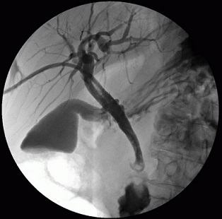 Percutaneous Transhepatic Cholangiography