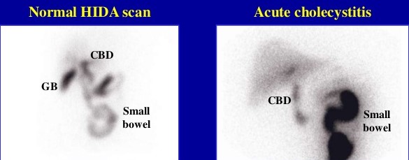 HIDA Scan of Acute Cholecystitis