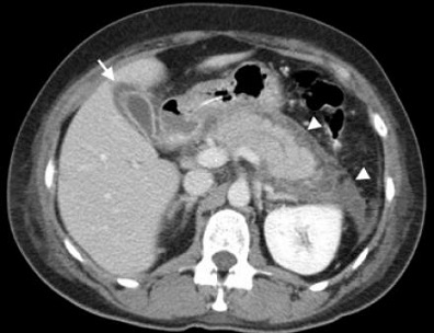 CT Scan of Acute Cholecystitis