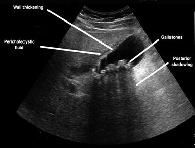 Ultrasound of Acute Cholecystitis