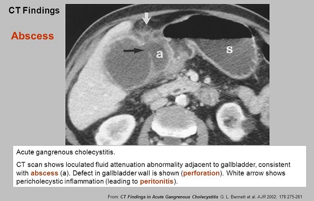 Pericholecystic Abscess