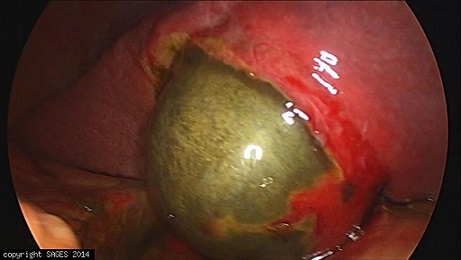 Gangrenous Gallbladder with Impending Perforation