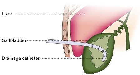 Cholecystostomy Tube