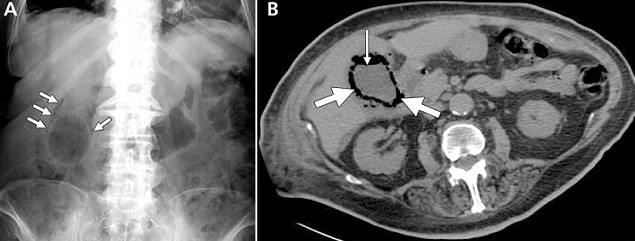 Emphysematous Cholecystitis