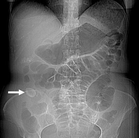 Gallstone Ileus