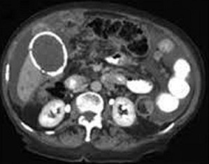 CT - Porcelain Gallbladder