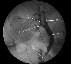 Cystic Duct Originating from the Right Hepatic duct