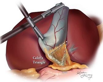 Calot's Triangle