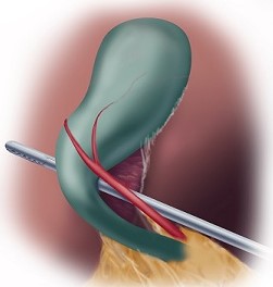 Critical View - Anterior