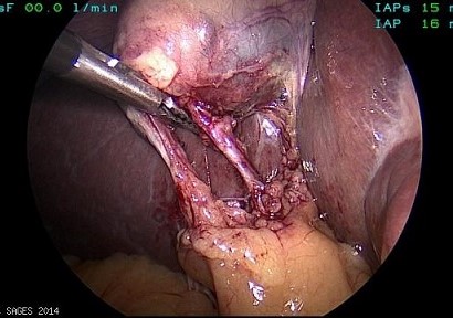 Critical View - Anterior