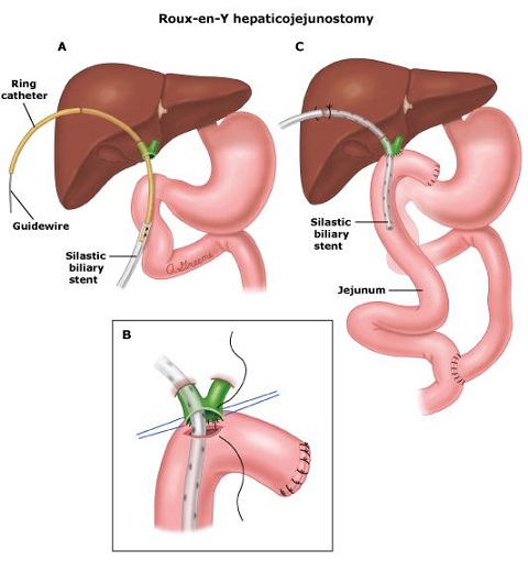 Hepaticojejunostomy with Stent