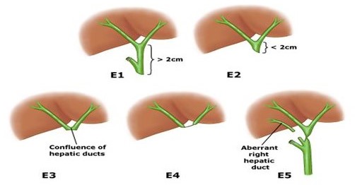 Strasberg Classification of MajorBile Duct Injuries